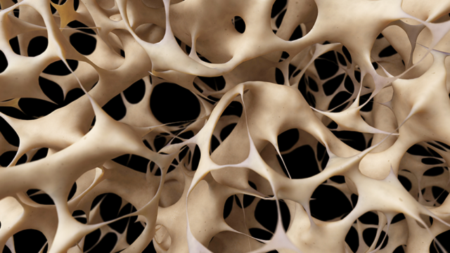 Osteoporóza, kosti, vápnik, rednutie kostnej hmoty, zlomeniny, menopauza