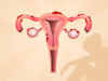 maternica, endometrióza, endometrium, vajíčkovody, vaječníky, podbrušie, menzes